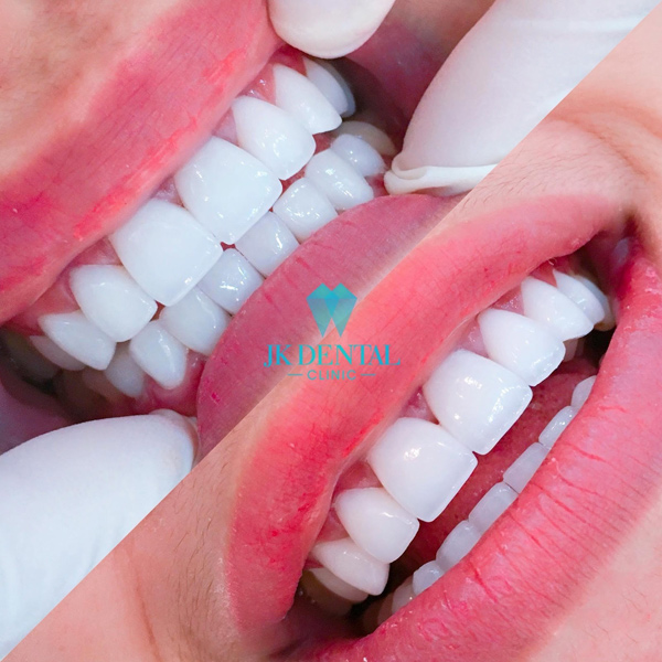 Đột phá công nghệ răng sứ thẩm mỹ tại Thẩm mỹ JK Dental - 2