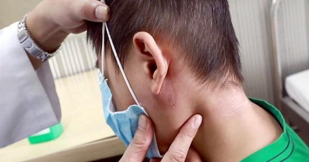 Sức khỏe đời sống - Gia tăng các ca mắc bệnh Whitmore, bệnh có lây từ người sang người?