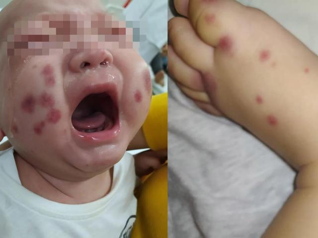 Sức khỏe đời sống - Chỉ sốt 1 ngày, bé trai mắc bệnh cực kỳ hiếm gặp, chưa từng có ở Việt Nam