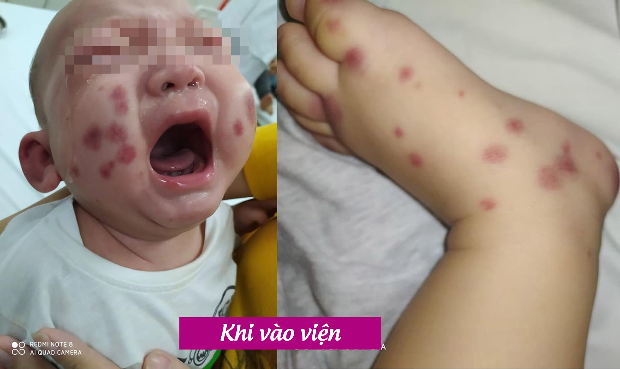 Chỉ sốt 1 ngày, bé trai mắc bệnh cực kỳ hiếm gặp, chưa từng có ở Việt Nam - 1
