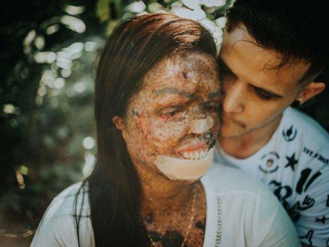 Bạn trẻ - Cuộc sống - Cô gái có làn da sần sùi như vỏ cây cưới chồng trẻ đẹp