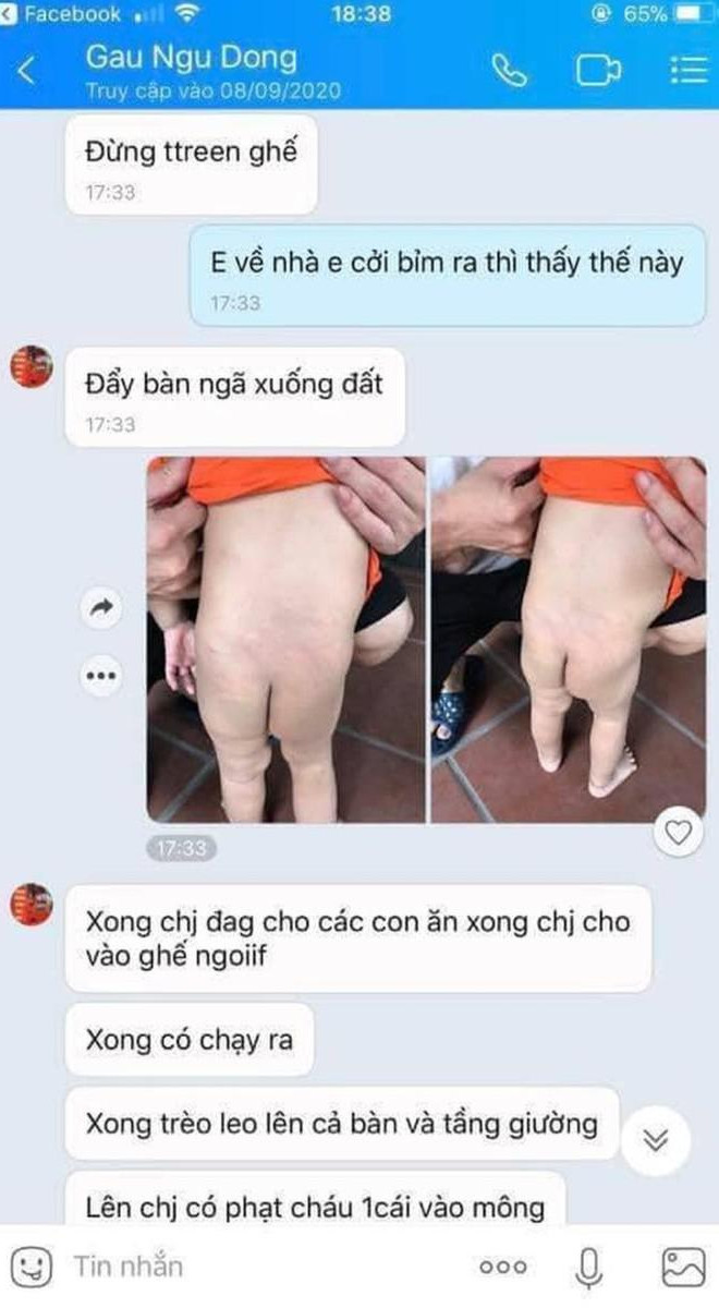 Đoạn hội thoại trao đổi của phụ huynh và giáo viên khi phát hiện con mình có vết đỏ ở mông.