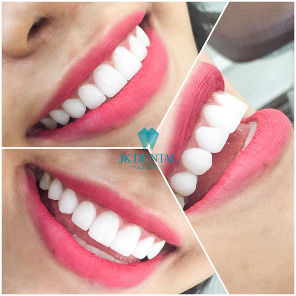 Giải đáp các câu hỏi về tẩy trắng răng tại Phòng khám nha khoa thẩm mỹ JK Dental - 1