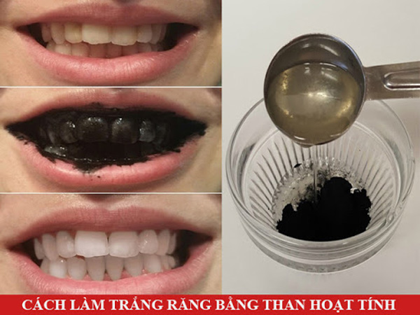 Giải đáp các câu hỏi về tẩy trắng răng tại Phòng khám nha khoa thẩm mỹ JK Dental - 2