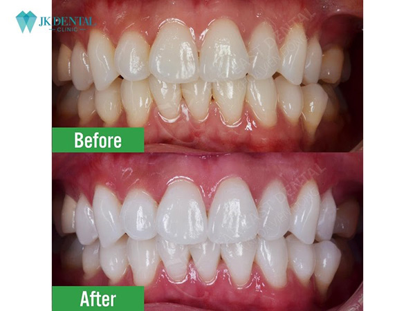 Giải đáp các câu hỏi về tẩy trắng răng tại Phòng khám nha khoa thẩm mỹ JK Dental - 5