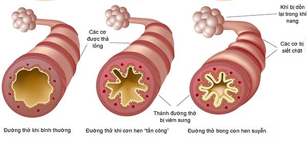 10 yếu tố khiến hen phế quản nặng lên - 1