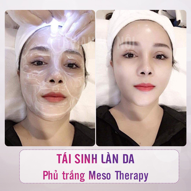 Phủ trắng Meso Therapy - công nghệ làm đẹp nổi tiếng Hàn Quốc đã có mặt tại Lavian - 1