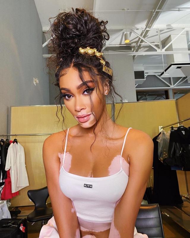 Winnie Harlow nói rằng đang nỗ lực để lấy lại dáng