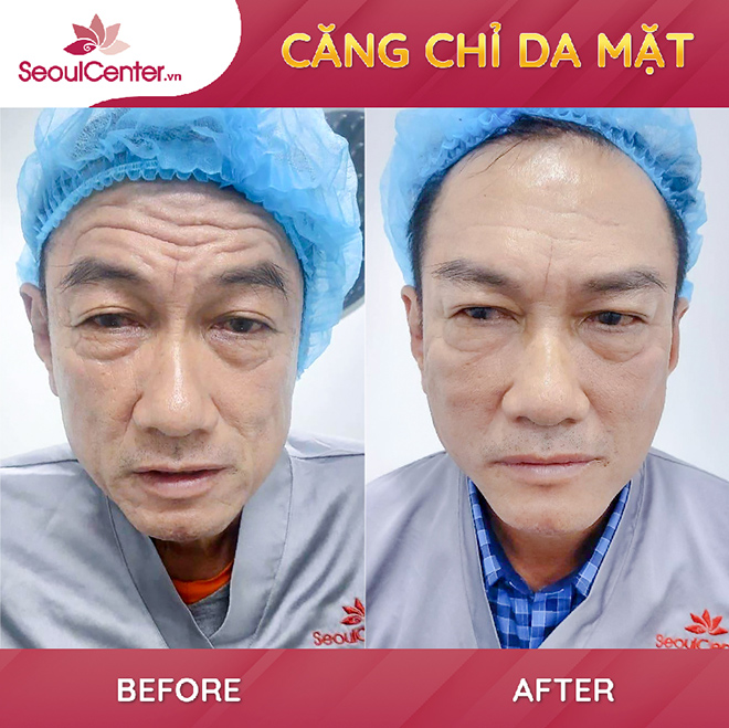 Quy trình căng chỉ collagen chuẩn an toàn tại Viện Thẩm mỹ SeoulCenter.Vn - 3