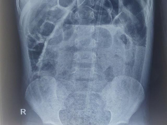 Sức khỏe đời sống - Bé trai 8 tuổi suýt vỡ ruột vì bị táo bón nhưng cha mẹ chủ quan