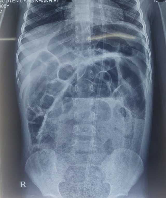 Hình ảnh X-quang các quai ruột giãn to.