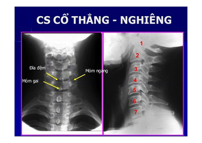 Liệt tay trái do gai cột sống cổ chèn ép thần kinh cũng cải thiện nhờ bí kíp này - 2