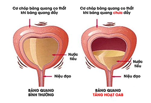 Tiểu đêm 3-4 lần, tiểu nhiều lần - dấu hiệu cảnh cáo bệnh nguy hiểm ở bàng quang đang rình rập - 2