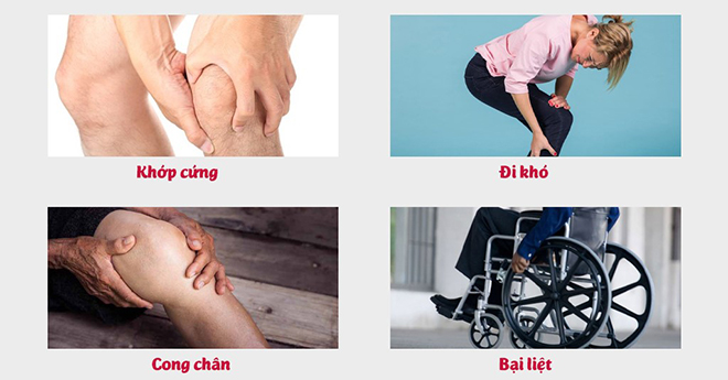 Nếu không điều trị đau nhức khớp gối có thể gây bại liệt