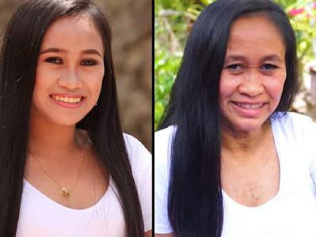 Sức khỏe đời sống - Cuộc sống của những thiếu nữ xinh đẹp bỗng mắc căn bệnh khiến gương mặt bất ngờ già đi hàng chục tuổi giờ ra sao?