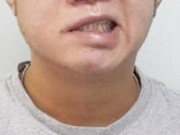 Sức khỏe đời sống - Người đàn ông ở Hà Nội bị méo miệng do thói quen hàng nghìn người mắc khi đi ngủ