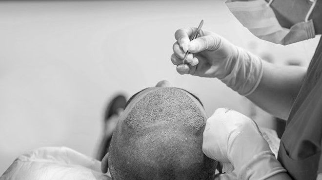 Giải pháp phục hồi mái tóc không phẫu thuật nhờ ứng dụng từ công nghệ Ballvic Matrix Hair - 1
