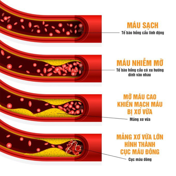 Nguy cơ mỡ máu gây đột quỵ sau tuổi 40 vào mùa lạnh! - 1