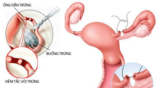Tắc ống dẫn trứng là một trong dấu hiệu có thể gây vô sinh ở nữ giới.