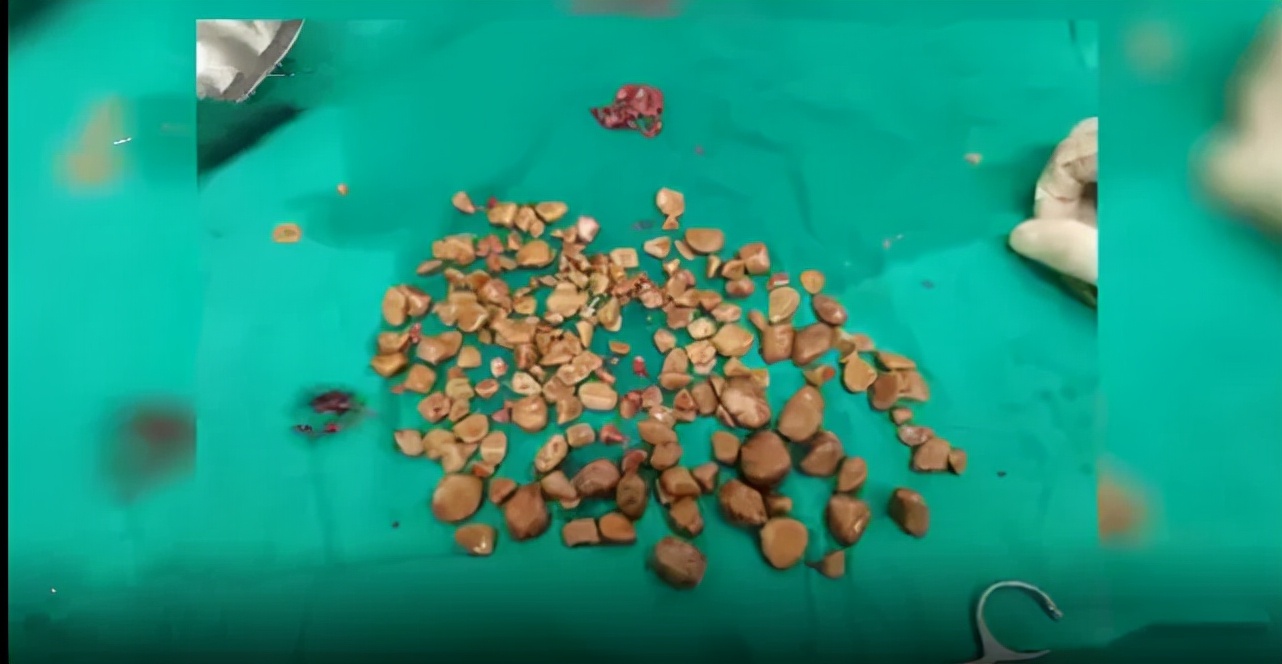 Những viên sỏi gắp ra từ bàng quang ông Trương.