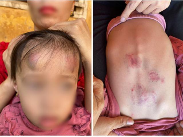 Tin tức trong ngày - Bé gái 2 tuổi ở Bắc Giang bị bạn cắn, đánh trong lớp học: Phòng GD&ĐT nói gì?