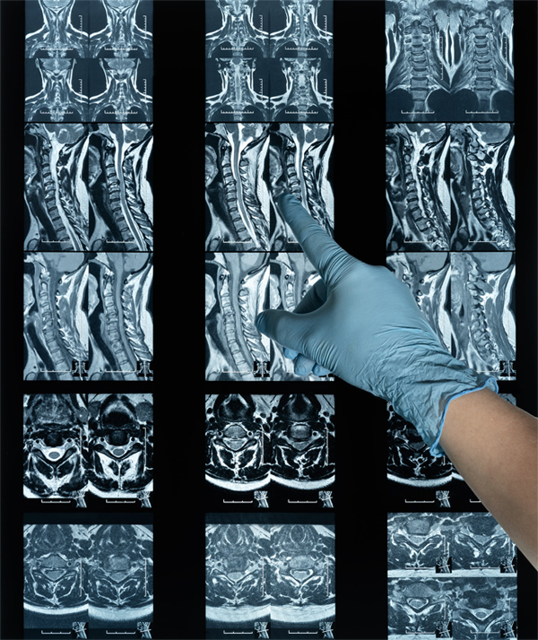 Quá trình thoái hóa được xem là nguyên nhân chính gây thoát vị đĩa đệm