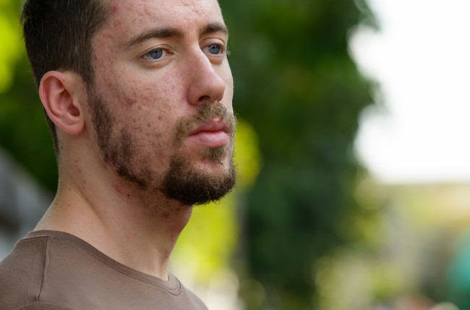 Mụn đinh râu là gì? Có nên nặn mụn đinh râu hay không? - 1