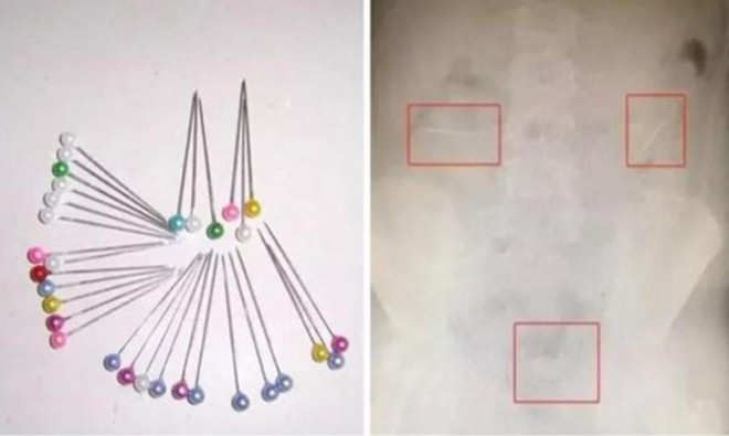Bé trai 10 tuổi nuốt&nbsp;4 chiếc đinh ghim vào bụng vì muốn chứng minh bản thân là ảo thuật gia.