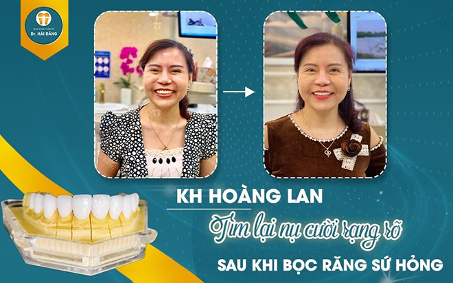 Cô Hoàng Lan trước và sau khi được kiến tạo lại nụ cười