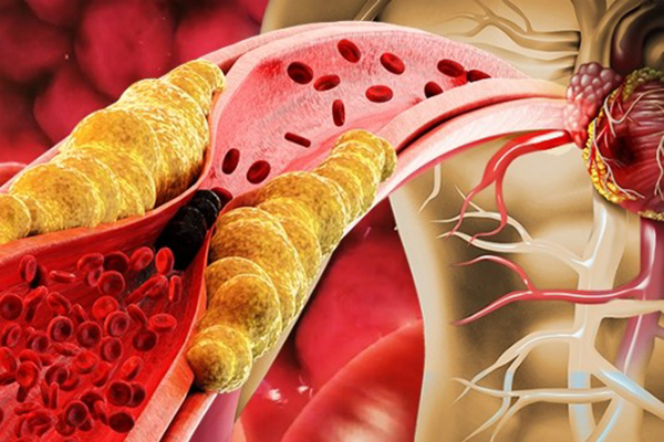 Bất ngờ với cách làm sạch máu, mạch máu và ngừa tai biến của người Nhật