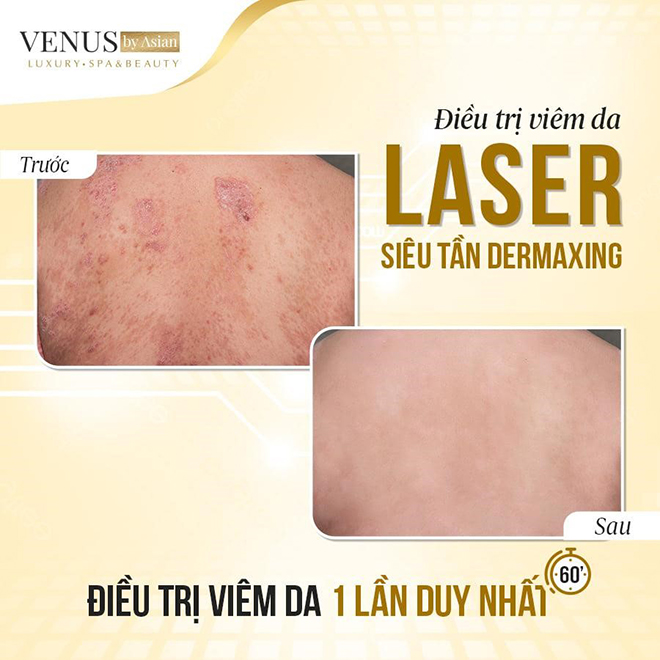 Laser siêu tần Dermaxing - phương pháp chữa viêm da này có gì đặc biệt? - 2