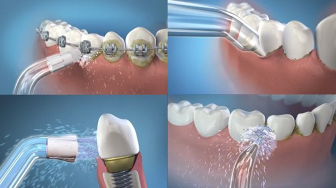 Máy tăm nước giúp loại bỏ sạch hơn vụn thức ăn còn sót lại