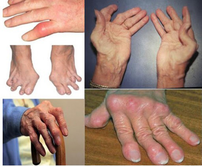 Hình ảnh bàn tay, bàn chân bị biến chứng do viêm khớp dạng thấp