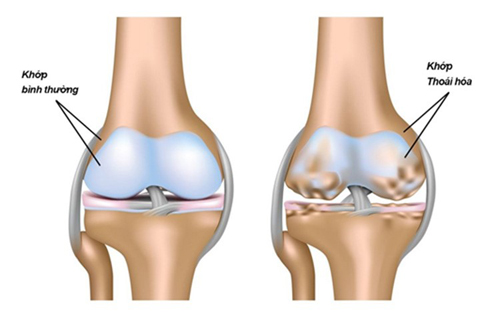 Thiếu hụt chất nền sụn khớp - Thủ phạm "sâu xa" gây đau nhức và thoái hoá xương khớp - 2