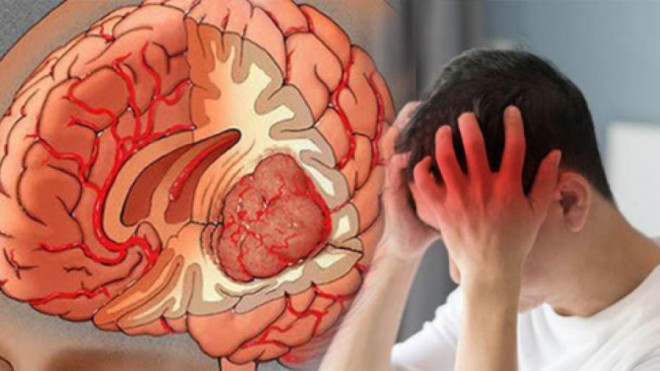 Đau đầu trầm trọng là biểu hiện thường gặp ở khoảng 50% số bệnh nhân u não (Ảnh minh họa)