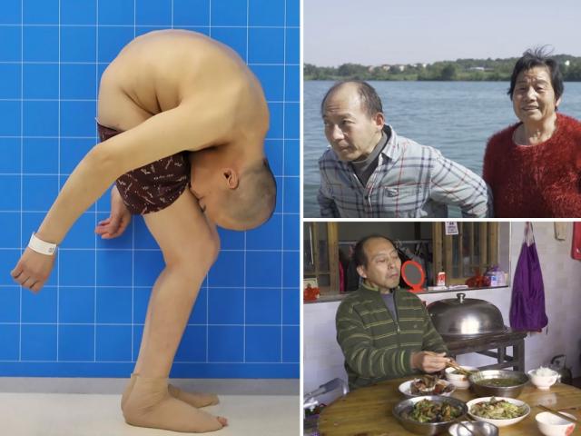 Phi thường - kỳ quặc - TQ: Liều mạng phẫu thuật, người đàn ông "gập đôi" gặp điều kỳ diệu