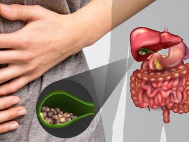 Sức khỏe đời sống - Sỏi túi mật "hóa thạch" trong người bệnh nhân, chuyên gia chỉ rõ điều chỉnh ngay chế độ ăn đề phòng bệnh