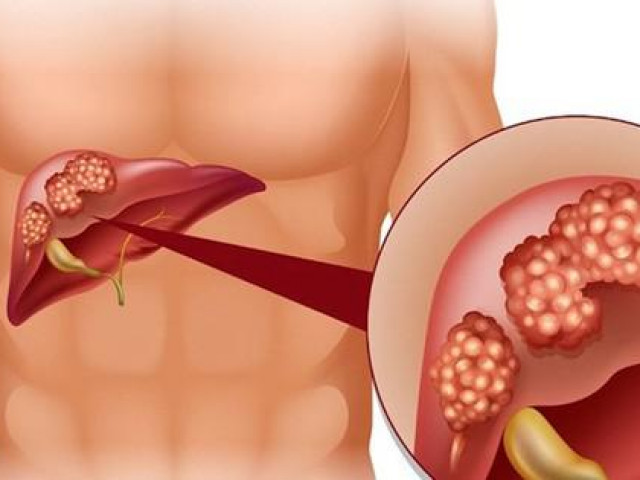 Sức khỏe đời sống - Để gan luôn khỏe mạnh, không viêm nhiễm nhất định phải làm tốt 4 điều này