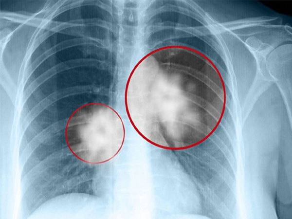 Hình ảnh bụi phổi amiang - một bệnh rất thường gặp do tiếp xúc amiang.