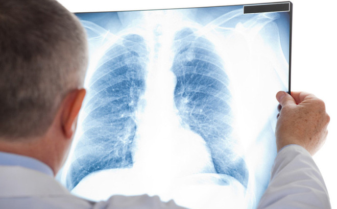 6 lầm tưởng về ung thư phổi khiến ai cũng ngỡ ngàng khi biết sự thật - 4