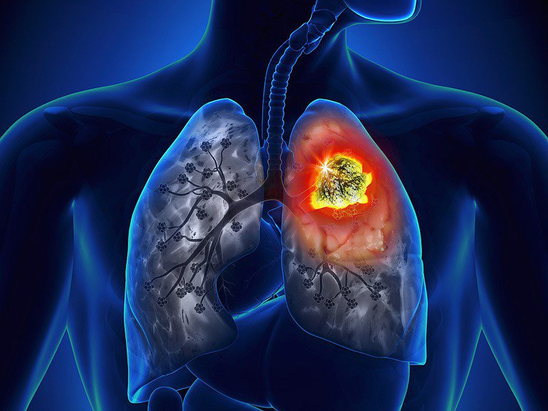 6 lầm tưởng về ung thư phổi khiến ai cũng ngỡ ngàng khi biết sự thật - 3