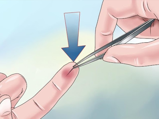 Media - Hậu quả khó lường khi bị dằm đâm vào tay quá lâu không rút ra