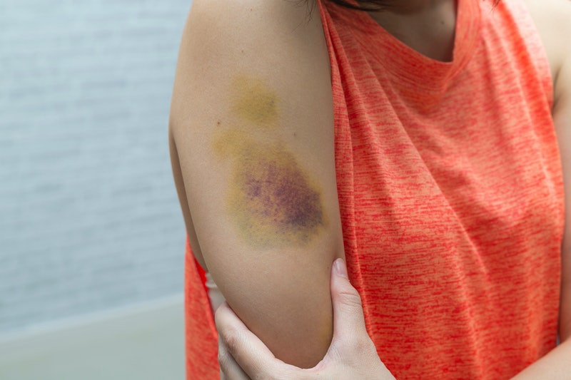 Cẩn trọng với những vết bầm tím trên da, rất có thể bạn đang mắc bệnh cực nguy hiểm - 4