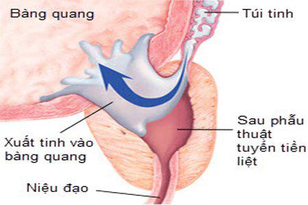 Xuất tinh ngược: Triệu chứng, nguyên nhân và cách phòng ngừa - 1