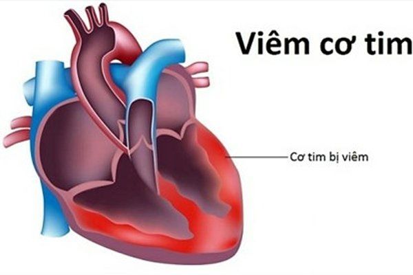 Sau tiêm vắc-xin phòng COVID-19: Có nên tập luyện thể dục thể thao? - 2