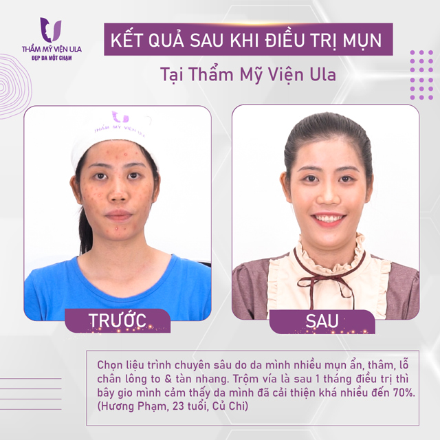 Thẩm mỹ viện trị mụn Ula Spa giúp nàng sở hữu làn da sáng mịn chuẩn sao Hàn - 4