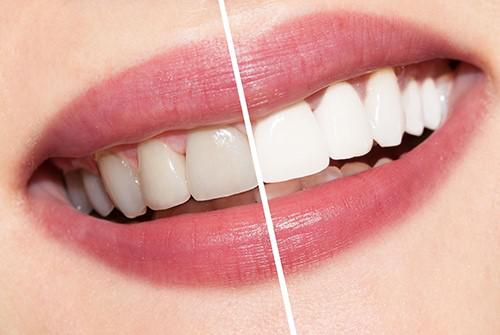 5 thói quen tàn phá răng lợi của bạn, không muốn hỏng răng sớm cần tránh ngay - 4