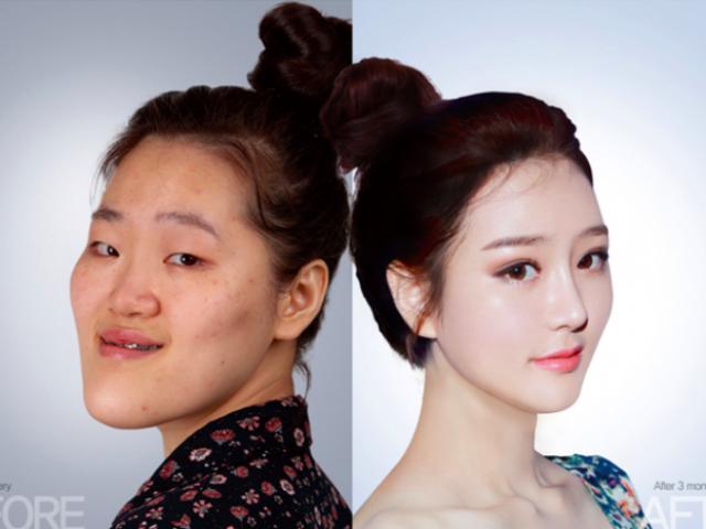 Làm đẹp - Phụ huynh Hàn Quốc đưa con đi "dao kéo" để đổi đời, có bé gái mới chỉ 8 tuổi
