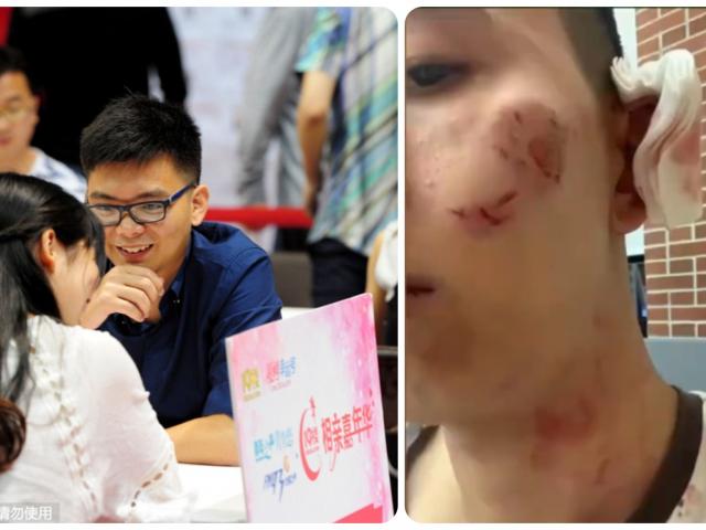 Thế giới - TQ: Đang đi đường bị thanh niên lao vào cắn rách mặt, giận "sôi máu" khi biết lý do