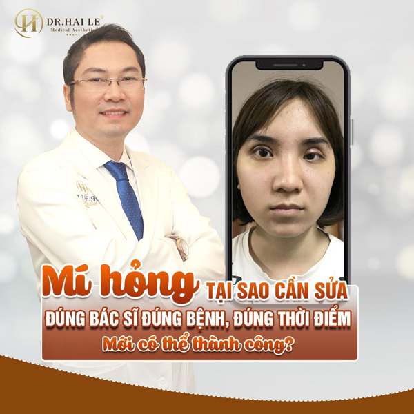 Dr.Hải Lê: Địa chỉ sửa mí mắt lỗi hỏng an toàn và uy tín tại Hà Nội - 2